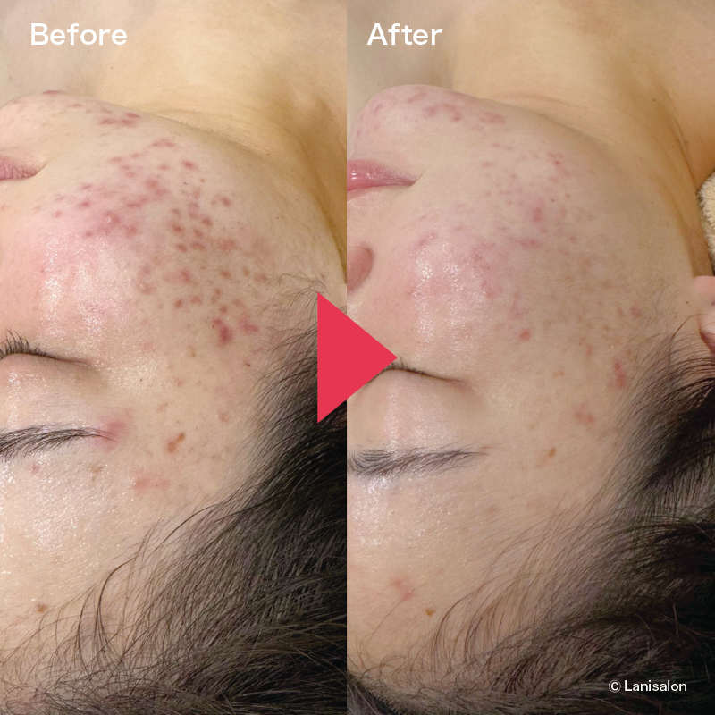 次世代ハーブピーリング | 松本市ハーブピーリング専門店｜美肌×陶肌