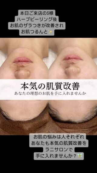 #松本市エステサロン#松本市脱毛#松本市痩身#ハーブピーリング#陶羽田トリートメント#フェイシャルエステ#肌質改善#美肌