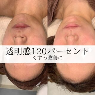 こんにちはラニサロンです。  本日ご来店のm様のご紹介です。
m様は最近お化粧のノリが悪くお顔のくすみを 
気にされてご来店されました。  カウンセリングをさせいただいたところ
m様はお顔の産毛も気にされていて
週1回のペースでお顔のシェービングをされてる
とのことでその刺激でお肌が乾燥しやすく、
少し口周りが色素沈着してしまっている状態でした。  なので本日は
ハーブピーリングをする前に
お顔の脱毛を先にお手入れし二週間後に
ハーブピーリングでお手入れすることを
オススメさせていただきました✨️  お顔の脱毛はただ光を照射するだけでなく
クレンジング→ウォッシング→お顔にジェル塗布→照射→お肌にあったパック→お仕上げ→日焼け止めまでしっかり40分お手入れさせていただきます😊
m様も写真でおわかりいただけるように
産毛もお肌もくすみもかなりトーンアップし
ゆっくりできたとのことで大変喜ばれてました🤍
m様のお肌が乾燥しやすい状態だったので
毎日のケアにラグジュアリーオイルを取り入れて
いただきご購入していただきました。  m様ご来店ありがとうございました。
次回も心よりお待ちしております。  お顔の脱毛をすることでお肌のトーンアップはもちろん
産毛がなくなることで美容液や化粧水の乳液なども浸透しやすくなりお化粧のノリもかなり良くなります💄
そこにハーブピーリングをすることで外的刺激で
傷ついたお肌の細胞を修復、強化させていきます。
毛穴が引き締まるのでお肌がとっても滑らかになりますよ。  ただご存知の通りお顔の産毛も1回だけでは完全になくならないので何回かお手入れしていく必要があるのですが
ハーブピーリングも加えてお手入れすることによってお肌の代謝がよくなって毛の抜けが良くなりますので脱毛の効果はもちろん美白作りに抜群です◎  最近くすみがち、化粧のノリが悪いな、産毛が気になるなというあなたに最適なメニューですよ🌿
是非ご来店お待ちいております。  ＊.｡.＊ﾟ＊.｡.＊ﾟ＊.｡.＊ﾟ＊.｡.＊ﾟ＊.｡.＊ﾟ＊.｡.＊ﾟ
30代からの大人女性の美肌作り
Aesthetic Lanisalon.【ラニサロン】
ハーブピーリング専門店🌿�
🏰👉長野県松本市中央1-23-2 Mウイング北棟1F（松本駅から徒歩5分）
＊.｡.＊ﾟ＊.｡.＊ﾟ＊.｡.＊ﾟ＊.｡.＊ﾟ＊.｡.＊ﾟ＊.｡.＊ﾟ  #松本市エステ #松本市エステサロン #松本市ハーブ #松本市ハーブピーリング #松本市美肌サロン #松本市フェイシャル #松本市フェイシャルエステ #松本市シミケア #松本市美容クリニック #松本市mウイング #松本駅