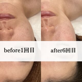 ．
こんにちはラニサロンです🌈
本日で6回目ご来店の30代前半のS様のご紹介です。  S様は10代の時にいろんな肌トラブルに悩まれており特に思春期ニキビに悩まれ
クリニックやいろんなケアをしてきたのですが
今はその名残りでクレーターや毛穴、シミがなかなか改善されず
悩まれてご来店されました。  一時は良かったり、また肌トラブルをおこしたりと繰り返す日々だったとのことです。  お肌を一緒に確認させていただくと
やはりターンオーバーが乱れてしまってる状態で古い角質がたまり厚くなってくすんで毛穴が詰まってる状態だと確認させていただきました。  1回目〜6回目までクレジング→ウォッシング→ゴマージュ→ハーブピーリング→セラム→お仕上げ→日焼け止めの順番でお手入れさせていただき、
しっかりS様のお悩み改善の為にオプションは栄養をたっぷり入れさせていただきたかってので毎回フルオプションで毎回ご提案させていただきました🙇‍♀️✨  6回目の今回お写真を撮らせていただいたのですが1回目のお肌もだいぶ柔らかくなりクレーターも少しずつ改善していってるのがわかりますね😊  ホームケアでも
まず最初にお肌を洗うところから見直していただくようアドバイスさせていただき強いオイルクレンジングは辞め
REVIのジェルタイプのクレンジングと
きめ細かいウォッシングに切り替えていただきました。クレンジングとウォッシングを見直すだけでも化粧水や乳液、クリームの入りが全く変わるからです🫧  S様も肌質がだいぶ変わったと喜んでいただい
て周りご友人にも褒めてもらうことが増えたそうです。
S様はしっかり肌質改善の為に今でも3週間に1回のペースでハーブピーリングに通っていただいております🌈
S様いつもご来店ありがとうございます☆  S様のようにクリニックで一時は改善したもののまた繰り返しトラブルを起こしてしまうというあなたの為に
お肌の根本、細胞からしっかりケアすることで
本気の肌質改善をラニサロンでいかがですか✨
是非ご来店お待ちしております🌈  ＊.｡.＊ﾟ＊.｡.＊ﾟ＊.｡.＊ﾟ＊.｡.＊ﾟ＊.｡.＊ﾟ＊.｡.＊ﾟ
30代からの大人女性の美肌作り
Aesthetic Lanisalon.【ラニサロン】
ハーブピーリング専門店🌿�
🏰👉長野県松本市中央1-23-2 Mウイング北棟1F（松本駅から徒歩5分）
＊.｡.＊ﾟ＊.｡.＊ﾟ＊.｡.＊ﾟ＊.｡.＊ﾟ＊.｡.＊ﾟ＊.｡.＊ﾟ  #松本市エステサロン #松本市エステ #松本市フェイシャル #松本市シミケア #松本市ハーブピーリング #松本市光フォト #松本市陶肌トリートメント #松本市mウイング #松本市サロン #シミ取り #幹細胞美容 #肌質改善 #エイジングケア化粧品