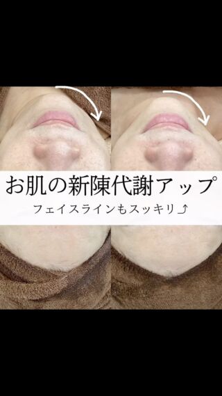 ．
こんにちは
ラニサロンです✨  一気に寒くなってきましたね⛄️🍂
不意に顔触ってみると
あれ、お顔が冷たい💦なんてことありませんか？  顔が冷えてると血行不良でお顔がくすみ
お肌に必要な栄養や酸素も行き届きにくく
なってしまいます。
それだけでなくターンオーバーが乱れてしまい
肌トラブルの原因になってしまいます🥲  顔冷えしてしまいがちな
こんな時期だからこそ  陶肌トリートメント+延髄スプレーガンは
いかがですか？💁‍♀️  延髄とは脳神経細胞の一種で
人の身体は脳が手足を動かしてと指令を
出したと同時に手足は動きますよね。
そのくらい早いスピードで
お肌の弱っている細胞に働きかけてくれるので
効果実感も早いですし
美肌、抗老化，シワ，毛穴、たるみ、ニキビ
様々な肌トラブルを改善してくれる
最先端の再生美容です🫣  お手入れの流れとしては
陶肌トリートメントで
ターンオーバーを促進して
栄養をたっぷり入れ込んだ後に
延髄スプレーガンで
陶肌セラム(延髄幹細胞美容液)を首からお顔に
たっぷりミストで吹きかけます。  ミストで吹きかけるので
お肌の内部までしっかり浸透してくれ
若返りへ導いてくれます🙆‍♀️
一瞬でお顔が潤い引き上がるので
フェイスラインもスッキリし効果実感抜群ですよ✨  お客様k様の陶肌トリートメントと
延髄スプレーガン後のビフォーアフターのお写真になります。
お肌にハリが出てフェイスラインがスッキリになられて喜ばれてました✨  この乾燥しやすい時期ですが
お肌の細胞を強化していくことで
肌トラブル起こしにくくすることができます。  お肌が健康だと笑顔も自然に増えて
毎日の生活が楽しくなりますよね🥹♪  あなたの為の健康な肌作りを
ラニサロンで一緒に叶えていきませんか💁‍♀️  是非ご来店心よりお待ちしております🙇‍♀️✨  ＊.｡.＊ﾟ＊.｡.＊ﾟ＊.｡.＊ﾟ＊.｡.＊ﾟ＊.｡.＊ﾟ＊.｡.＊ﾟ
30代からの大人女性の美肌作り
Aesthetic Lanisalon.【ラニサロン】
ハーブピーリング専門店🌿�
🏰👉長野県松本市中央1-23-2 Mウイング北棟1F（松本駅から徒歩5分）
＊.｡.＊ﾟ＊.｡.＊ﾟ＊.｡.＊ﾟ＊.｡.＊ﾟ＊.｡.＊ﾟ＊.｡.＊ﾟ  #松本市エステサロン #松本市エステ #松本市フェイシャル #松本市シミケア #松本市ハーブピーリング #松本市光フォト #松本市陶肌トリートメント #松本市mウイング #松本市サロン #シミ取り #幹細胞美容 #肌質改善 #エイジングケア化粧品
