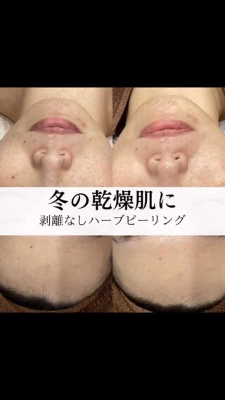 ．
こんにちはラニサロンです。  寒い日々が続いてますね*❄️·̩͙
本日ご来店のN様のご紹介です💁‍♀️  N様この11月に入ってから
お顔の乾燥が酷く肌荒れに悩まれて
ご来店されました。  お肌の状態を見させて頂くと
全体的に乾燥してしまい
くすんでしまって
外的刺激を受けやすく肌トラブルを起こしやすい状態に。  カウンセリングしていくと
普段のスキンケアもなかなか仕事が夜勤も多かったりで忙しく疲れてしまう為十分に時間をかけてできないとの事でした。  その為今回のお手入れは
お身体もお疲れの様子だったので背中とデコルテのマッサージを加えてゆっくり休んで頂き  ハーブピーリングのオプションは
シルクパウダーで水分量をあげ
お肌が疲れてくすんでしまっていたので
NMNとセラムのオプションをつけさせていただきました🌿‬  お手入れ後はしっかり奥まで水分量があがり潤った感じがするのとお肌かなりトーンが上がり顎のトラブルも少し落ち着いた感じが分かりますね🧚‍♀️
N様も触った瞬間から「全然違う！」と
喜ばれてました😊  N様に
ホームケアでもルヴィソームのラグジュアリー
オイルマスクをアドバイスし取り入れてもらいました。  ハーブピーリングの効果も持続しやすく
お仕事がお忙しいN様にもシートマスクはお顔に貼るだけなので手軽に簡単にお手入れができます。タヌマオイルが配合されており
火傷やアトピー性皮膚炎にも効果があるというエビデンスが出ており、驚異の抗酸化力誇り
抗炎症効果、ニキビ、ニキビ跡、日焼け、おシミ、おシワなどにも⋆⸜🙆🏻‍♀️⸝‍⋆
「奇跡の万能薬」として知られているのでこの乾燥しやすい時期にピッタリなホームケアのアイテムです⋆⸜🙆🏻‍♀️⸝‍⋆  N様またご来店ありがとうございました。
また次回も心よりお待ちしております🙇‍♀️🌈  この時期は本当に乾燥しやすく肌トラブルが出きやすいですよね。
普段のお手入れをしてても何か足りなかったり追いつかなかったり、肌状態が変わったり…どんなお手入れをしていいのか分からないなんて方もいらっしゃると思います。  ラニサロンではしっかりカウンセリングしお肌の状態を見させて頂き的確なアドバイスをさせて頂きます🙇‍♀️
この冬は肌トラブルに負けない美肌作りを一緒にしていきませんか？
是非ご来店お待ちしております🌈  ＊.｡.＊ﾟ＊.｡.＊ﾟ＊.｡.＊ﾟ＊.｡.＊ﾟ＊.｡.＊ﾟ＊.｡.＊ﾟ
30代からの大人女性の美肌作り
Aesthetic Lanisalon.【ラニサロン】
ハーブピーリング専門店🌿�
🏰👉長野県松本市中央1-23-2 Mウイング北棟1F（松本駅から徒歩5分）
＊.｡.＊ﾟ＊.｡.＊ﾟ＊.｡.＊ﾟ＊.｡.＊ﾟ＊.｡.＊ﾟ＊.｡.＊ﾟ  #松本市エステサロン #松本市エステ #松本市フェイシャル #松本市シミケア #松本市ハーブピーリング #松本市光フォト #松本市陶肌トリートメント #松本市mウイング #松本市サロン #シミ取り #幹細胞美容 #肌質改善 #エイジングケア化粧